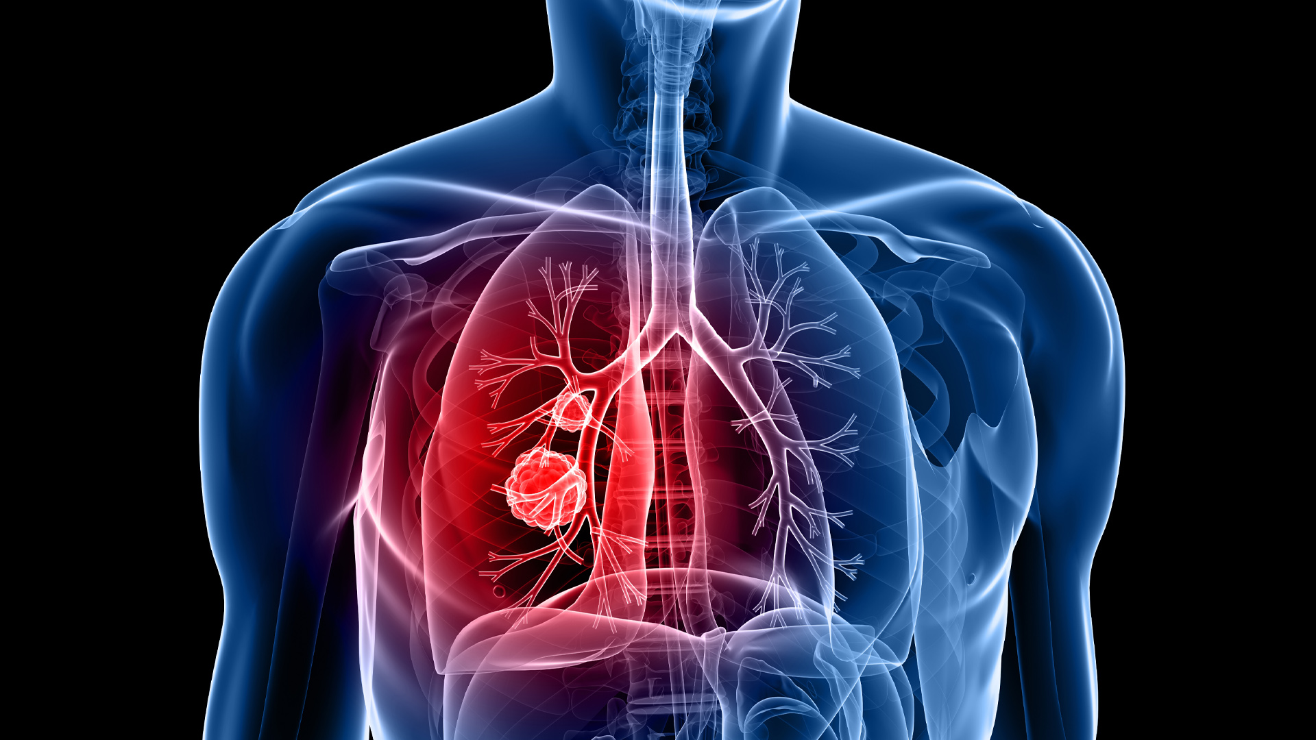 Chronic obstructive pulmonary disease (COPD) is the name for a group of lung conditions that cause breathing difficultie…
